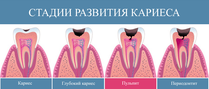 Стадии развития кариеса зубов